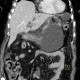 Biloma, complication of biliary drainage, PTC: CT - Computed tomography